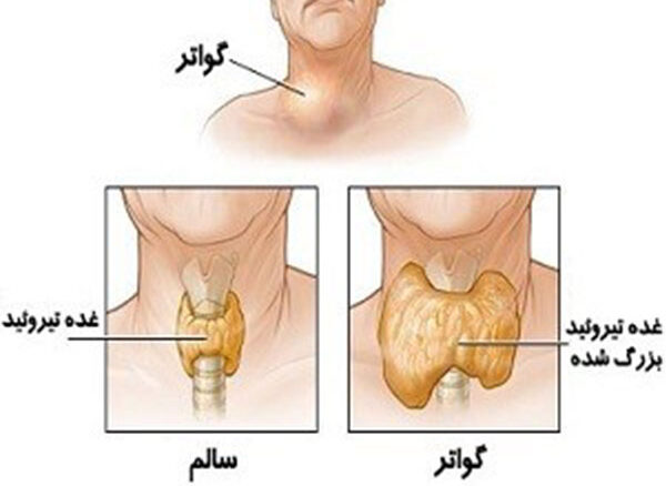 ﺗﯿﺮوﺋﯿﺪﮐﺘﻮﻣﯽ