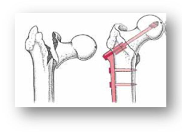 شکستگی قسمت پایین گردن استخوان ران