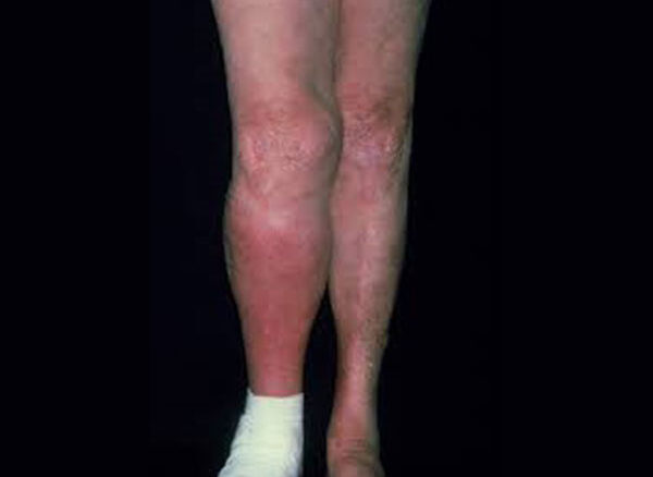 ترومبوز ورید عمقی (DVT)